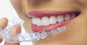Lưu ý khi niềng răng Invisalign