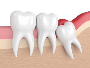 Cách phân biệt răng cấm và răng khôn