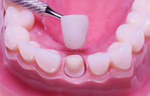 Có cần lấy tủy răng trước khi bọc răng sứ hay không