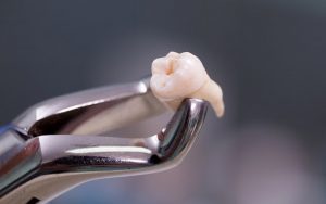 Răng khôn thật sự Rất ngu