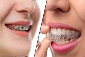 Niềng răng là gì? Lợi ích khi niềng răng