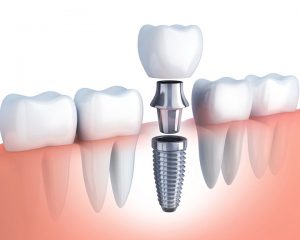 Chăm Sóc Răng Trồng Implant Như Thế Nào?
