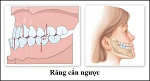 Khớp cắn ngược