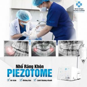 Nhổ răng khôn bằng máy khác gì phương pháp cũ?
