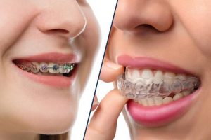 Nẹp răng trong bao lâu thì được tháo?