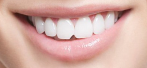 Sứt mẻ răng