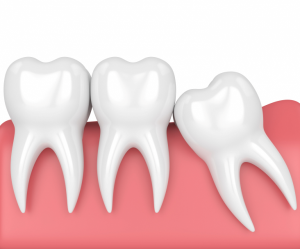 Răng mọc lệch xử lý cách nào?