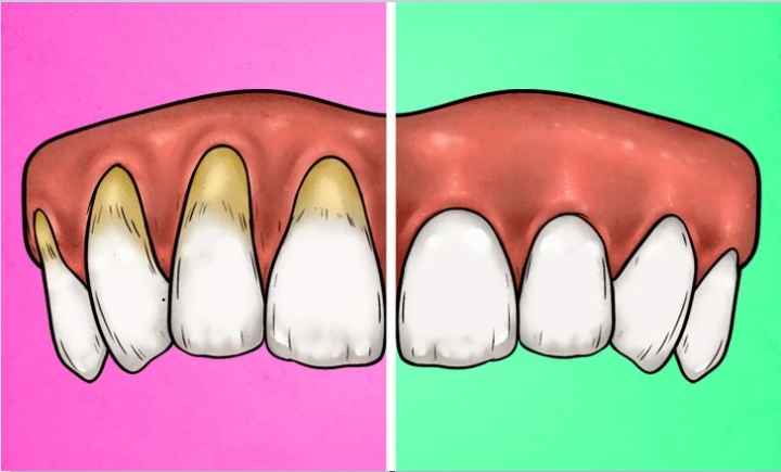 4 dấu hiệu cảnh báo bạn đang đánh răng quá kỹ và cách khắc phục