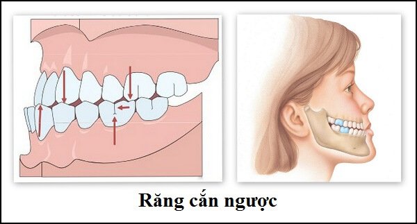 Chỉnh hình răng hàm mặt