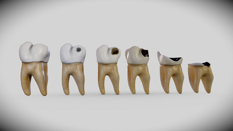 Răng bị mục: Nguyên nhân, dấu hiệu và phương pháp điều trị