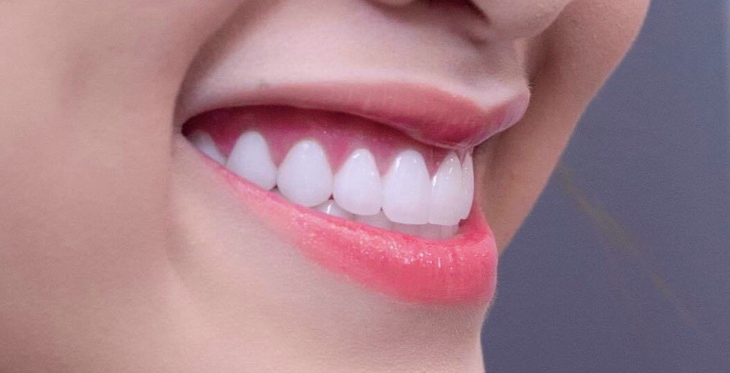 Làm răng sứ hết bao nhiêu tiền để có nụ cười rạng rỡ?