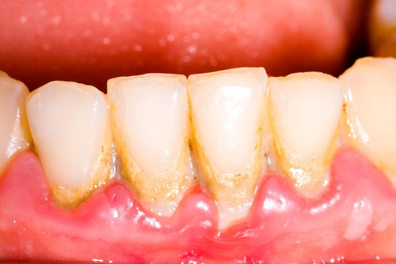 Răng bị mục: Nguyên nhân, dấu hiệu và phương pháp điều trị