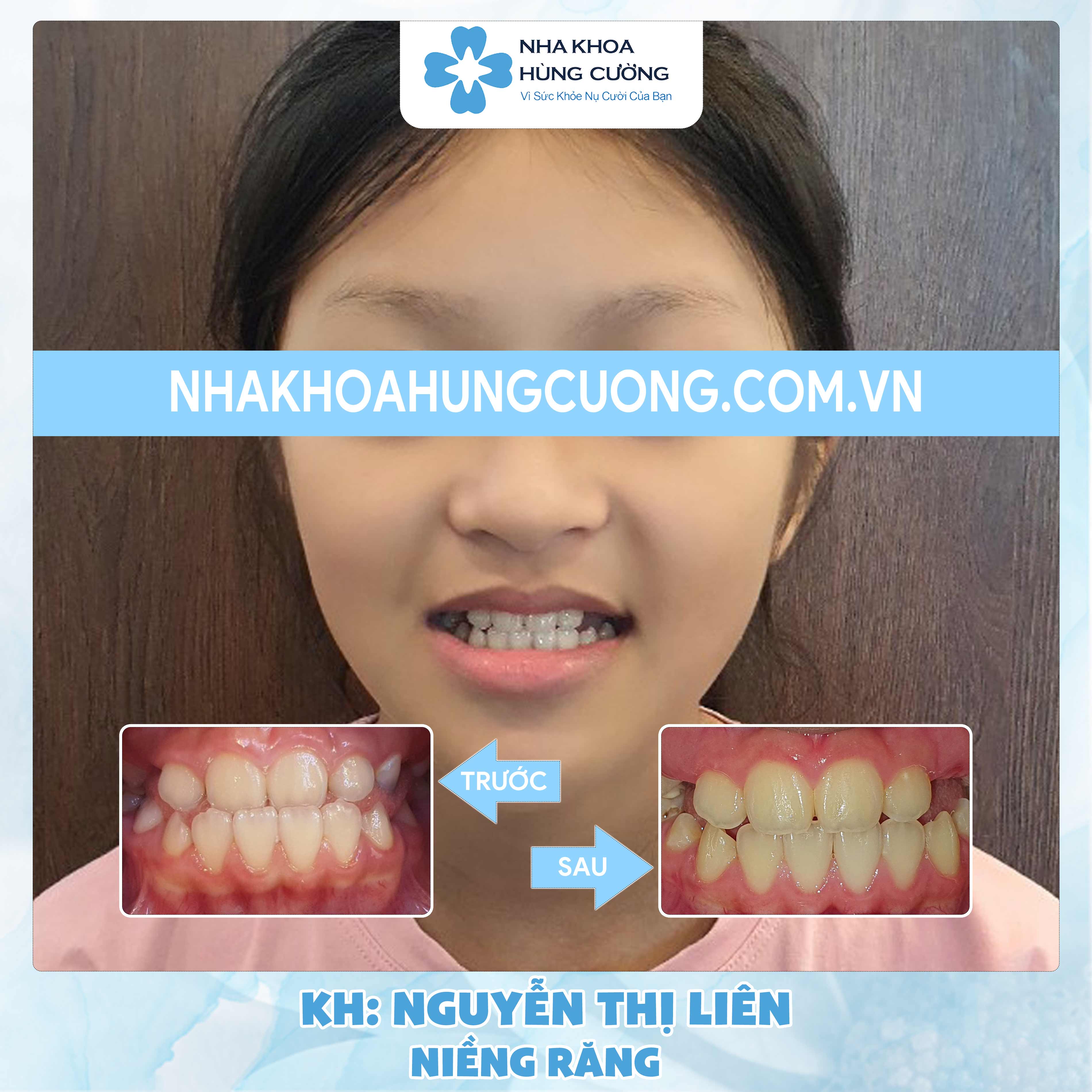 Dịch vụ Niềng răng – Khách hàng Nguyễn Thị Liên