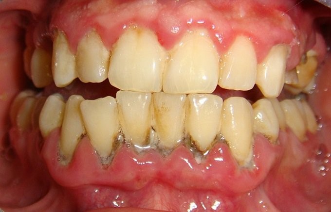 Tác hại của cao răng (vôi răng)