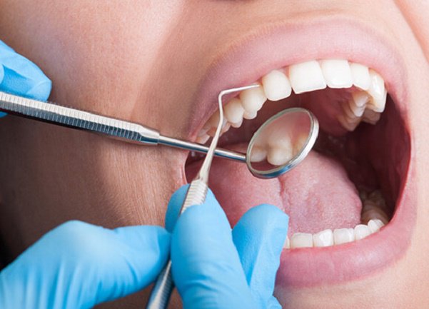 Nên lấy cao răng bao lâu một lần?