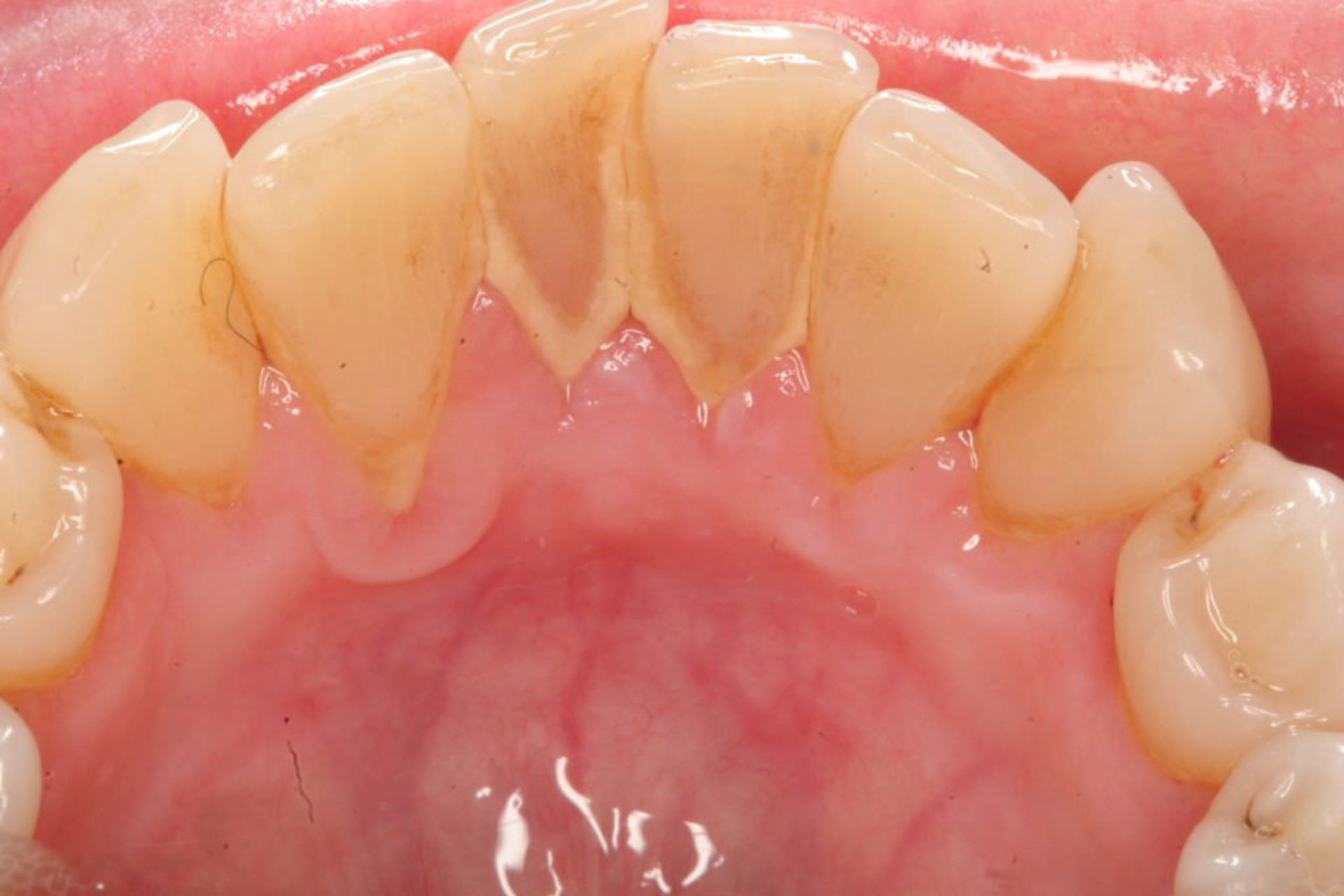 Cao răng hình thành thế nào?