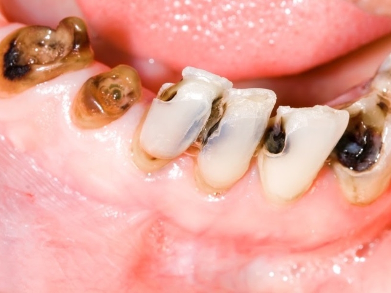 Bị sâu răng có lây sang răng khác không?